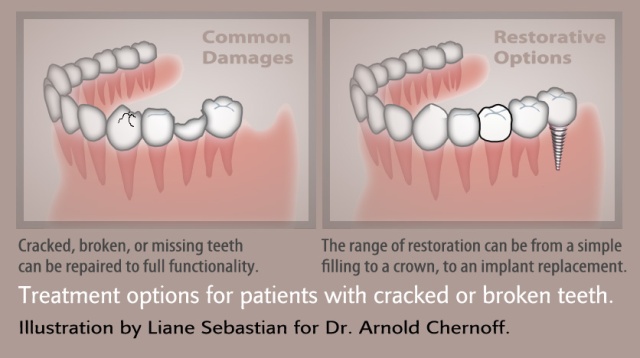 Succinct illustration for Dr. Arnold Chernoff to explain options to patients who have damaged teeth. Before and After drawing approach by illustrator Liane Sebastian shows the solutions instantly.