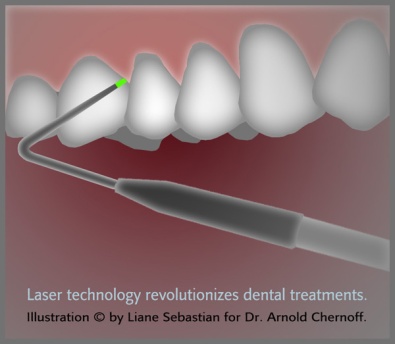 Professional dental illustration to portray laser precision to patients, created by Liane Sebastian for Dr. Arnold Chernoff, Evanston, IL